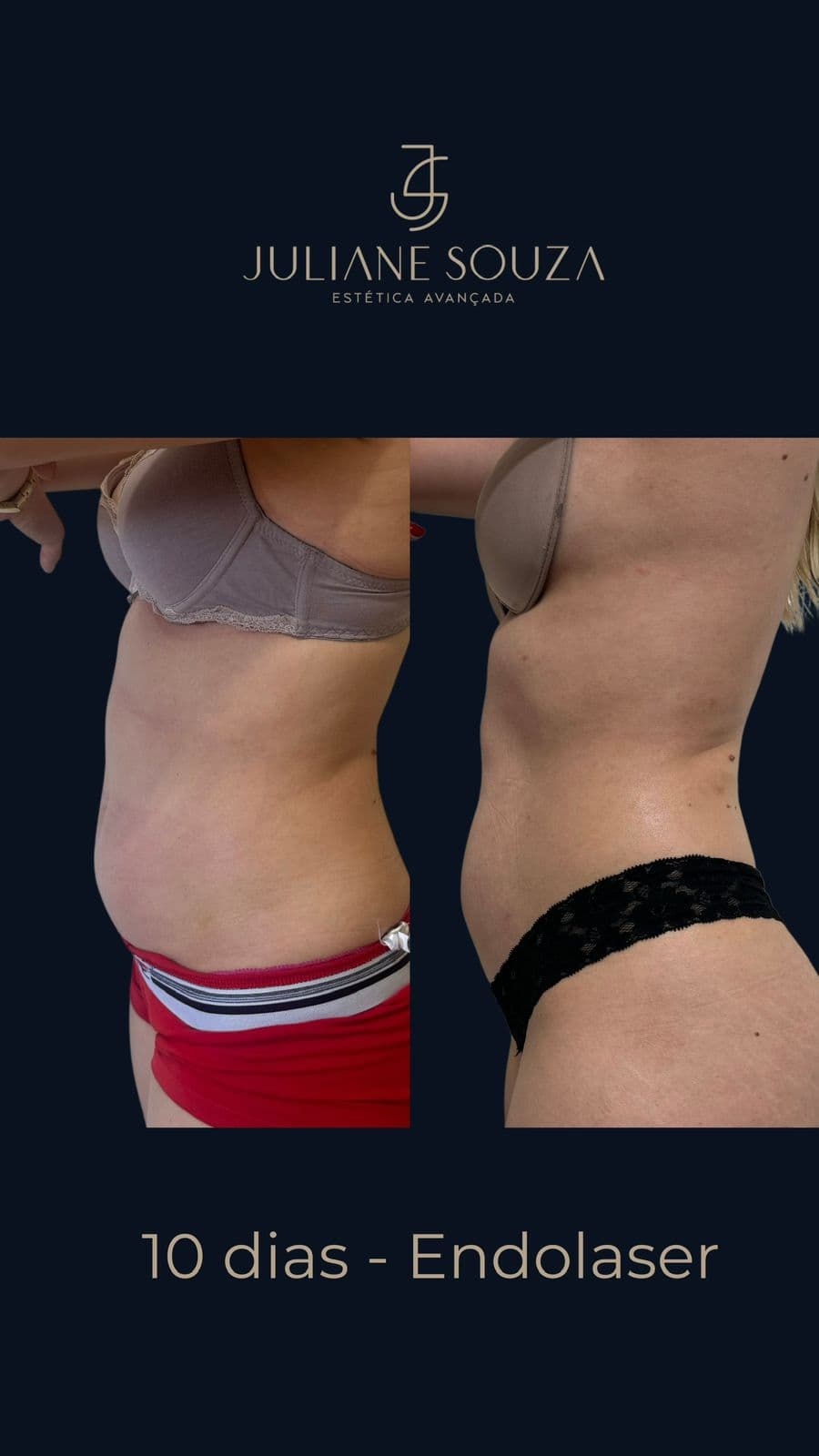 Endolaser: O Tratamento Que Une Redução de Gordura e Combate à Flacidez