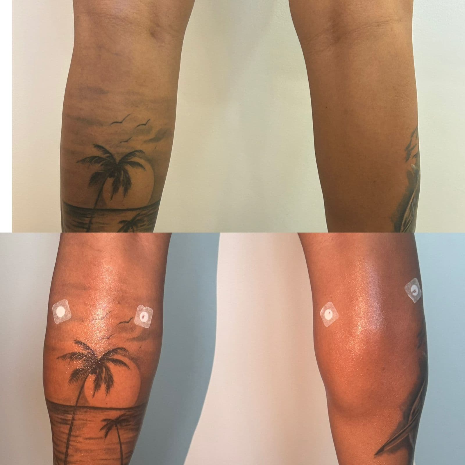 Harmonização de Panturrilha: Volume e Contorno Sem Cirurgia