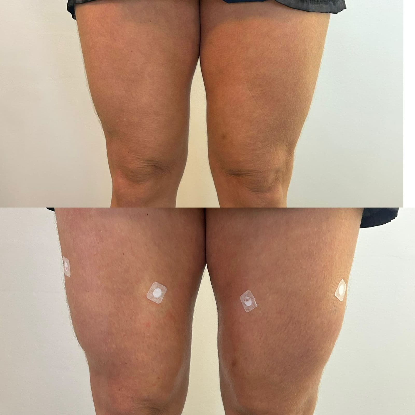 Harmonização de Quadríceps: Definição Muscular Sem Passar por Academia