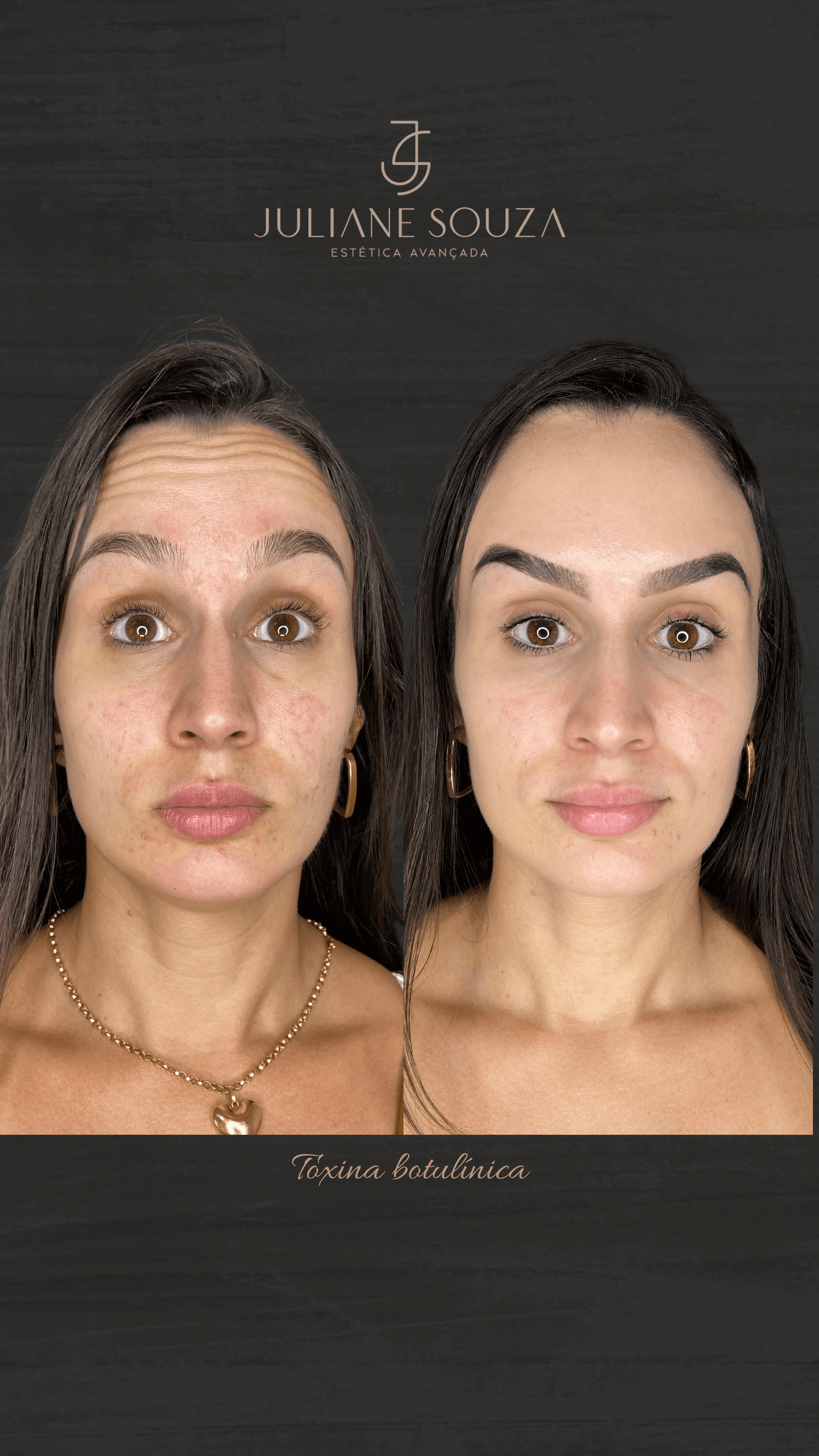 Tratamento Antirrugas antes e depois 01