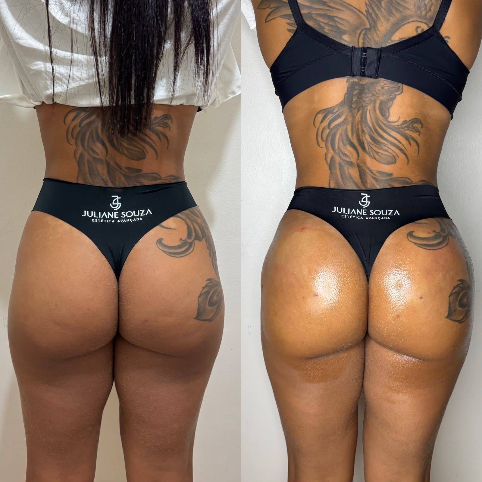Gluteoplastia Não Cirúrgica antes e depois 01