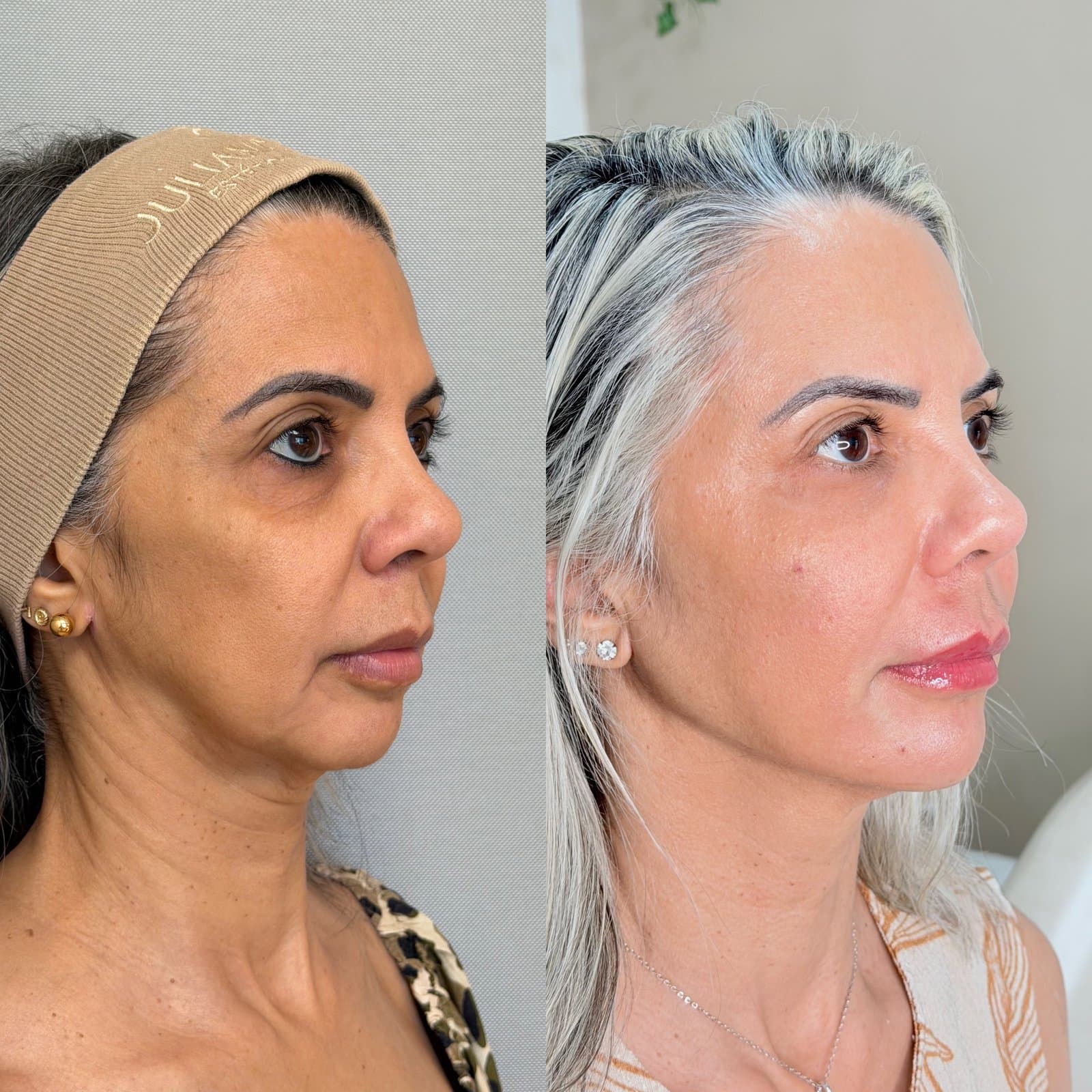 Harmonização Facial Feminina antes e depois 01