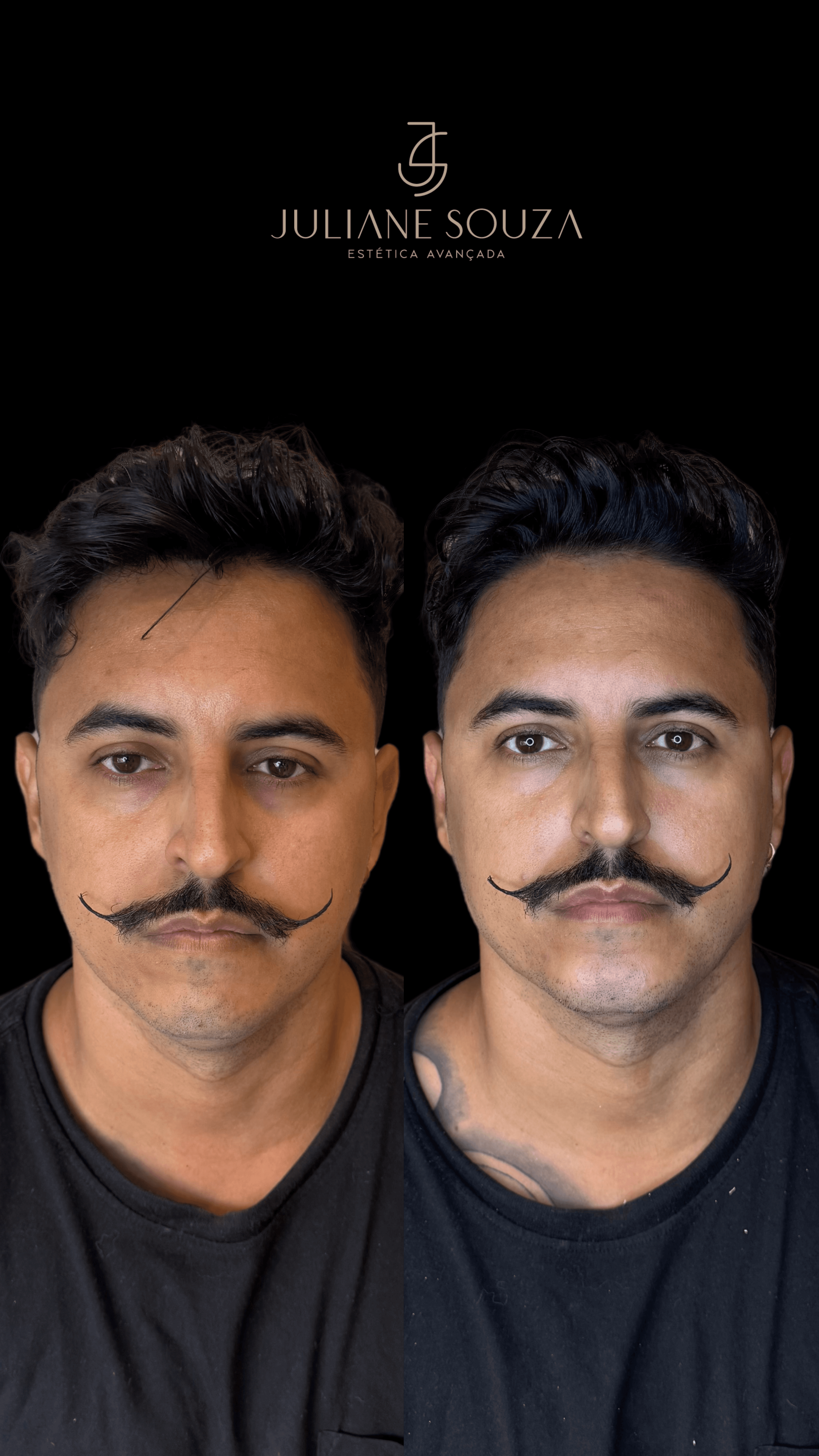 Harmonização Facial Masculina antes e depois 01