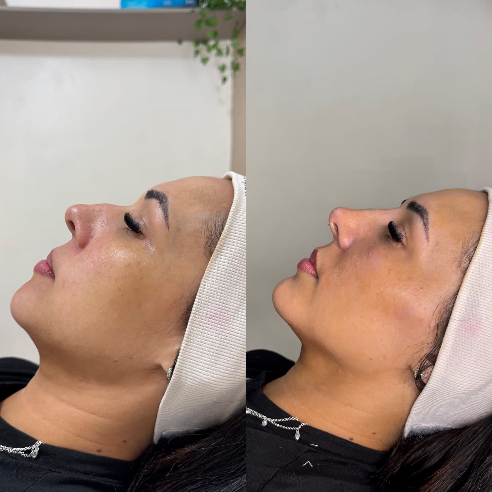 Perfiloplastia antes e depois 01